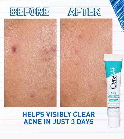 Cerave Acne Control Gel